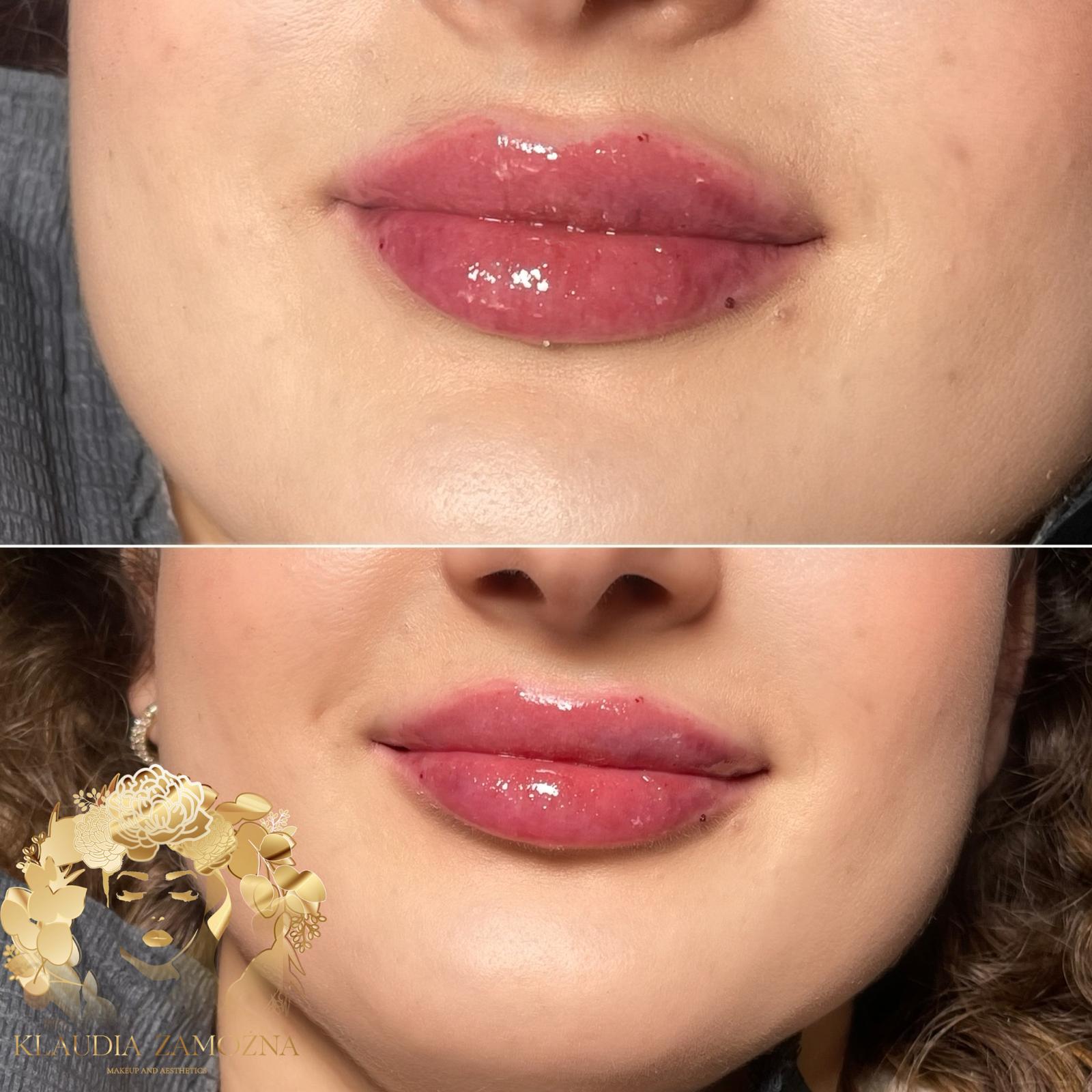 Dermal Filler