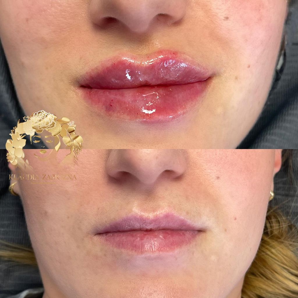 Dermal Filler