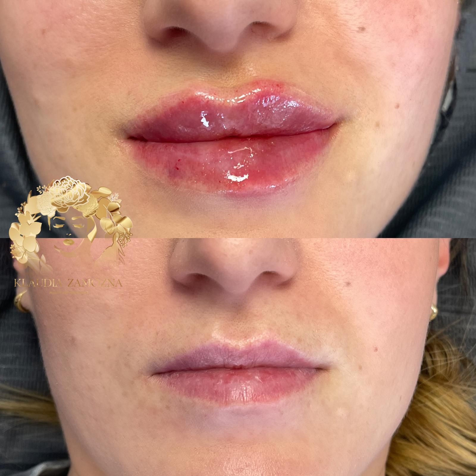 Dermal Filler